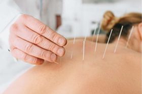 Dry-Needling physio