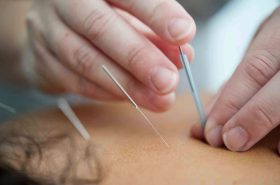 Dry Needling | Adelaide Physio and Podiatry Clinic