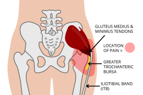 Gluteal+Tendinopathy