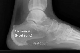 Heel Spur | Adelaide Physio and Podiatry Clinic