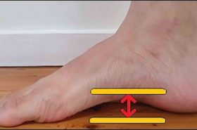 High Arched Feet | Adelaide Physio and Podiatry Clinic