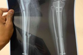 Osteoporosis | Adelaide Physio and Podiatry Clinic