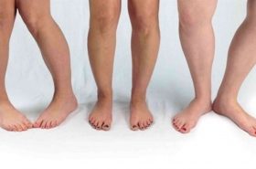 Out-Toeing | Adelaide Physio and Podiatry Clinic